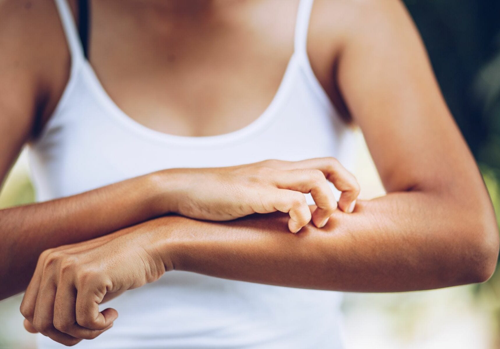 Young women hand scratch the itch on the arm, healthcare and med